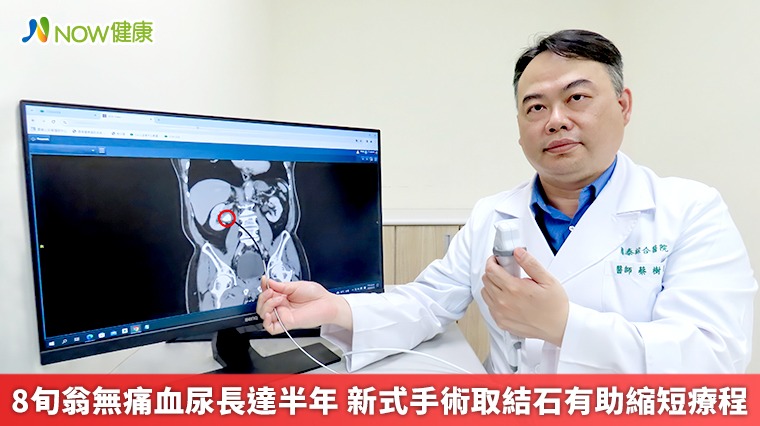 8旬翁無痛血尿長達半年 新式手術取結石有助縮短療程 8旬翁無痛血尿長達半年 新式手術取結石有助縮短療程